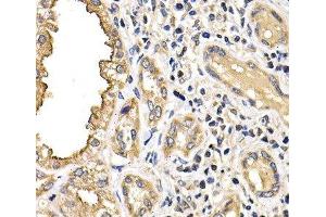 Immunohistochemistry of paraffin-embedded Human kidney cancer using ARRB2 Polyclonal Antibody at dilution of 1:200 (40x lens). (Arrestin 3 antibody)