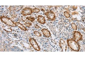 Immunohistochemistry of paraffin-embedded Human lung cancer tissue using CD108 Polyclonal Antibody at dilution 1:35 (SEMA7A antibody)