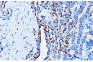 Immunohistochemistry of paraffin-embedded Human thyroid cancer using DDIT3 / CHOP Polyclonal Antibody at dilution of 1:100 (40x lens). (DDIT3 antibody)