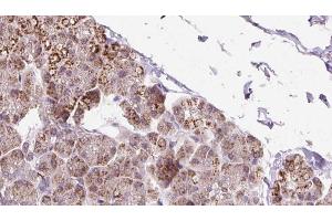 ABIN6273239 at 1/100 staining Human pancreas cancer tissue by IHC-P. (ETFDH antibody  (C-Term))