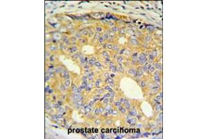 ZNF9 Antibody IHC analysis in formalin fixed and paraffin embedded prostate carcinoma followed by peroxidase conjugation of the secondary antibody and DAB staining.