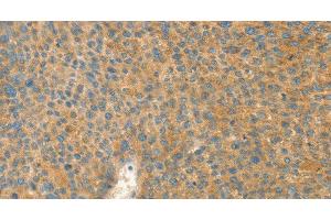Immunohistochemistry of paraffin-embedded Human liver cancer tissue using AANAT Polyclonal Antibody at dilution 1:40 (AANAT antibody)
