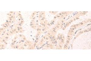 Immunohistochemistry of paraffin-embedded Human thyroid cancer tissue using IL7 Polyclonal Antibody at dilution of 1:30(x200) (IL-7 antibody)