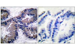 Immunohistochemical analysis of paraffin-embedded human lung carcinoma tissue, using NFE2L2 antibody (ABIN5976469). (NRF2 antibody  (C-Term))