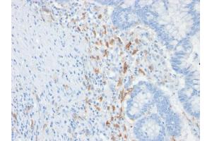 Formalin-fixed, paraffin-embedded human Colon Carcinoma stained with CD209 Mouse Monoclonal Antibody (C209/1781). (DC-SIGN/CD209 antibody)
