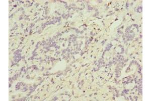 Immunohistochemistry of paraffin-embedded human lung cancer using ABIN7144847 at dilution of 1:100 (ATP5F1D antibody  (AA 1-168))