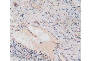 IHC-P analysis of Human Liver Cancer Tissue, with DAB staining. (Amphiregulin antibody  (AA 20-100))