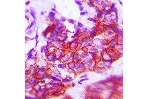 Immunohistochemical analysis of TRK A staining in human breast cancer formalin fixed paraffin embedded tissue section.