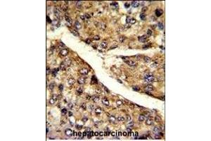 Formalin-fixed and paraffin-embedded human hepatocarcinoma reacted with FMO3 Antibody (N-term), which was peroxidase-conjugated to the secondary antibody, followed by DAB staining. (FMO3 antibody  (N-Term))