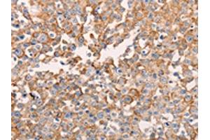The image on the left is immunohistochemistry of paraffin-embedded Human breast cancer tissue using ABIN7129618(GNA11 Antibody) at dilution 1/40, on the right is treated with fusion protein. (GNA11 antibody)