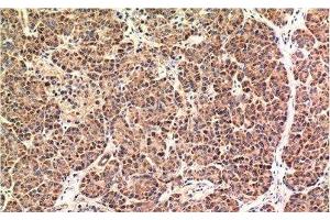 Immunohistochemistry of paraffin-embedded Human pancreas carcinoma tissue using CHOP Monoclonal Antibody at dilution of 1:200. (DDIT3 antibody)
