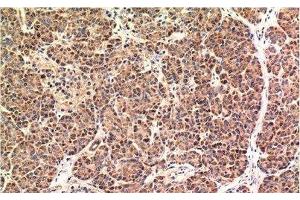 Immunohistochemistry of paraffin-embedded Human pancreas carcinoma tissue using CHOP Monoclonal Antibody at dilution of 1:200. (DDIT3 antibody)