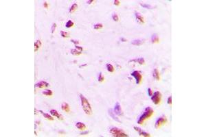 Immunohistochemical analysis of p53 (AcK381) staining in human lung cancer formalin fixed paraffin embedded tissue section. (p53 antibody  (acLys381, C-Term))