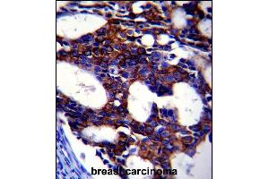 TGFB2 Antibody (ABIN659106 and ABIN2838086) immunohistochemistry analysis in formalin fixed and paraffin embedded human breast carcinoma followed by peroxidase conjμgation of the secondary antibody and DAB staining. (TGFB2 antibody)