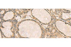 Immunohistochemistry of paraffin-embedded Human thyroid cancer tissue using CXCL1 Polyclonal Antibody at dilution of 1:35(x200) (CXCL1 antibody)