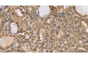 Immunohistochemistry of paraffin-embedded Human thyroid cancer using CENPV Polyclonal Antibody at dilution of 1:40 (CENPV antibody)