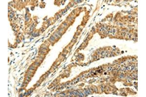 The image on the left is immunohistochemistry of paraffin-embedded Human esophagus cancer tissue using ABIN7128060(UBL4B Antibody) at dilution 1/25, on the right is treated with fusion protein. (UBL4B antibody)