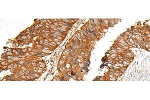 Immunohistochemistry of paraffin-embedded Human colorectal cancer tissue using MBOAT4 Polyclonal Antibody at dilution of 1:30(x200) (MBOAT4 antibody)
