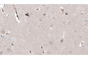ABIN6273005 at 1/100 staining Human brain cancer tissue by IHC-P.