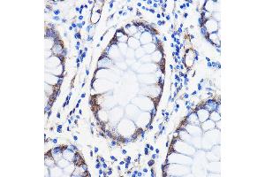 Immunohistochemistry of paraffin-embedded Human colon carcinoma using /// Rabbit pAb (ABIN7265627) at dilution of 1:50 (40x lens). (ANT1+ANT2+ANT3+ANT4 (C-Term) antibody)