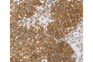 Immunohistochemistry of Human breast cancer using TPD52L2 Polyclonal Antibody at dilution of 1:35 (TPD52L2 antibody)