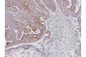 IHC-P Image Immunohistochemical analysis of paraffin-embedded N87 xenograft, using MAPK9, antibody at 1:100 dilution. (JNK2 antibody)