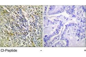 Immunohistochemical analysis of paraffin-embedded human lung carcinoma tissue using ACAN polyclonal antibody .