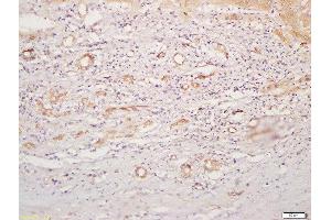 Formalin-fixed and paraffin embedded human liver carcinoma labeled with Rabbit Anti-CD4 Polyclonal Antibody, Unconjugated  at 1:200 followed by conjugation to the secondary antibody and DAB staining (CD4 antibody  (AA 301-400))