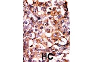Formalin-fixed and paraffin-embedded human cancer tissue reacted with the primary antibody, which was peroxidase-conjugated to the secondary antibody, followed by AEC staining. (MAPKAP Kinase 2 antibody  (pSer272))