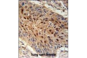 C4orf31 Antibody (N-term) (ABIN651996 and ABIN2840488) immunohistochemistry analysis in formalin fixed and paraffin embedded human lung carcinoma followed by peroxidase conjugation of the secondary antibody and DAB staining.