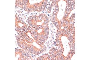 Immunohistochemistry of paraffin-embedded human colon carcinoma using TI antibody (ABIN6130725, ABIN6149146, ABIN6149147 and ABIN6214431) at dilution of 1:100 (40x lens). (TIAM1 antibody  (AA 1392-1591))