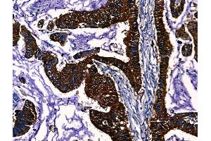 ABIN7094633 and ABIN7098683 at 1/100 staining Human liver cancer by IHC-P. (PGAM2 antibody  (Internal Region))