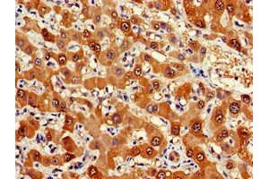 Immunohistochemistry of paraffin-embedded human liver cancer using ABIN7152571 at dilution of 1:100 (FDPS antibody  (AA 1-419))