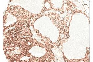 Immunohistochemical staining of paraffin-embedded Hepatocellular carcinoma Huh7 xenograft using Angiotensinogen antibody at a dilution of 1:100 (AGT antibody)