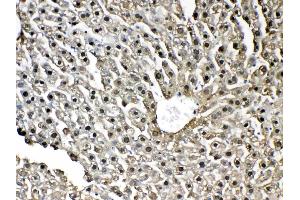 IHC analysis of GST3 / GST pi using anti-GST3 / GST pi antibody . (GSTP1 antibody  (AA 2-210))