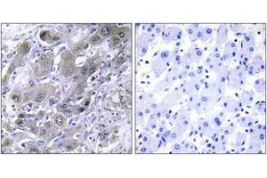 Immunohistochemistry analysis of paraffin-embedded human liver carcinoma tissue, using MRPS18A Antibody.