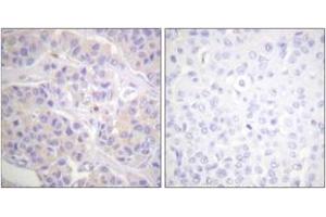Immunohistochemistry analysis of paraffin-embedded human breast carcinoma tissue, using p130 Cas (Ab-165) Antibody. (BCAR1 antibody  (AA 131-180))