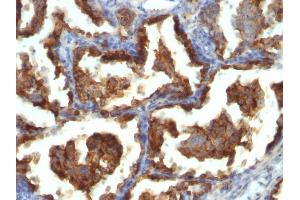 Immunohistochemistry (IHC) image for anti-Mucin 1 (MUC1) antibody (ABIN6940096)