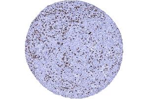 Squamous cell carcinoma containing numerous CD8 positive tumor infiltrating lymphocytes (Recombinant CD8 antibody  (AA 135-235))