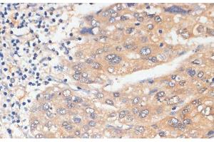Immunohistochemistry of paraffin-embedded Human liver cancer using WNK3 Polyclonal Antibody at dilution of 1:100 (40x lens). (WNK3 antibody)