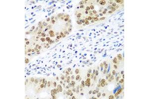 Immunohistochemistry of paraffin-embedded human colon carcinoma using MDC1 antibody at dilution of 1:100 (40x lens).