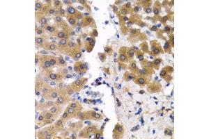 Immunohistochemistry of paraffin-embedded human liver cancer using SCP2 antibody. (SCP2 antibody)