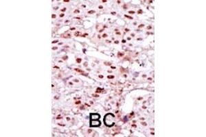 Formalin-fixed and paraffin-embedded human cancer tissue reacted with the primary antibody, which was peroxidase-conjugated to the secondary antibody, followed by DAB staining. (CSNK2A1/CK II alpha antibody  (AA 240-269))