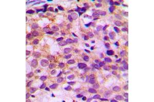 Immunohistochemical analysis of Ataxin 7L1 staining in human breast cancer formalin fixed paraffin embedded tissue section. (ATXN7L1 antibody  (Center))