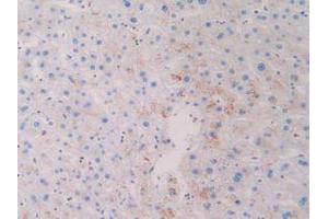 IHC-P analysis of Human Skin Cancer Tissue, with DAB staining. (CD63 antibody  (AA 103-203))