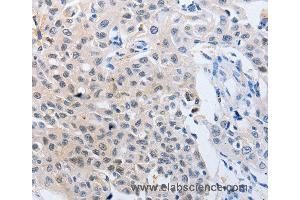 Immunohistochemistry of Human lung cancer using YWHAQ Polyclonal Antibody at dilution of 1:50 (14-3-3 theta antibody)