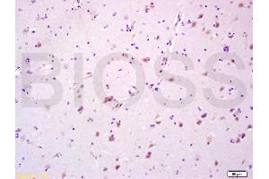 Formalin-fixed and paraffin embedded human glioma tissue labeled with Anti-CYP3A4 Polyclonal Antibody, Unconjugated (ABIN733793) at 1:200 followed by conjugation to the secondary antibody and DAB staining (CYP3A4 antibody  (AA 18-120))