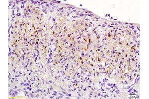 Formalin-fixed and paraffin embedded: rat uterine myoma labeled with Anti-PR (progesterone receptor) Polyclonal Antibody , Unconjugated 1:200 followed by conjugation to the secondary antibody and DAB staining (Progesterone Receptor antibody  (AA 501-600))