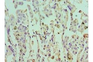 Immunohistochemistry of paraffin-embedded human lung cancer using ABIN7152105 at dilution of 1:100