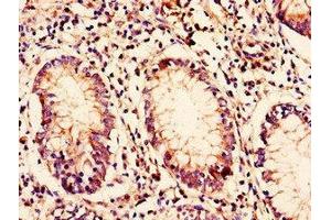 Immunohistochemistry of paraffin-embedded human colon cancer using ABIN7145632 at dilution of 1:100 (C10ORF32 antibody  (AA 2-105))